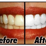 best-teeth-whitening